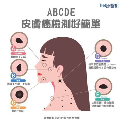 身體長誌|皮膚長痣、長斑是皮膚癌前兆？皮膚癌初期4大症狀快。